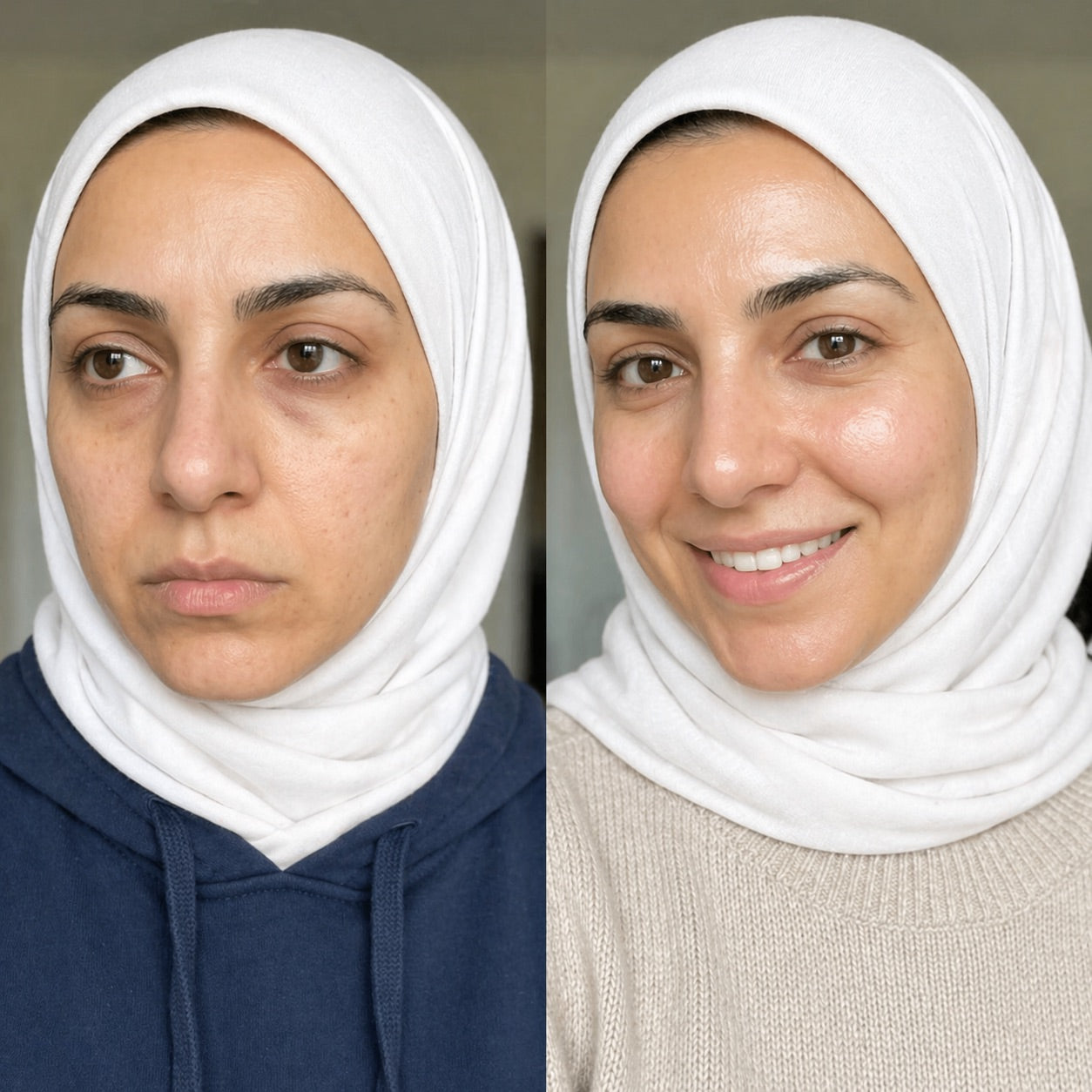 Before and after skincare transformation showing improved hydration, healthier skin barrier, and smoother, plumper skin after using the Derma Botox 3-Step Skincare Routine.