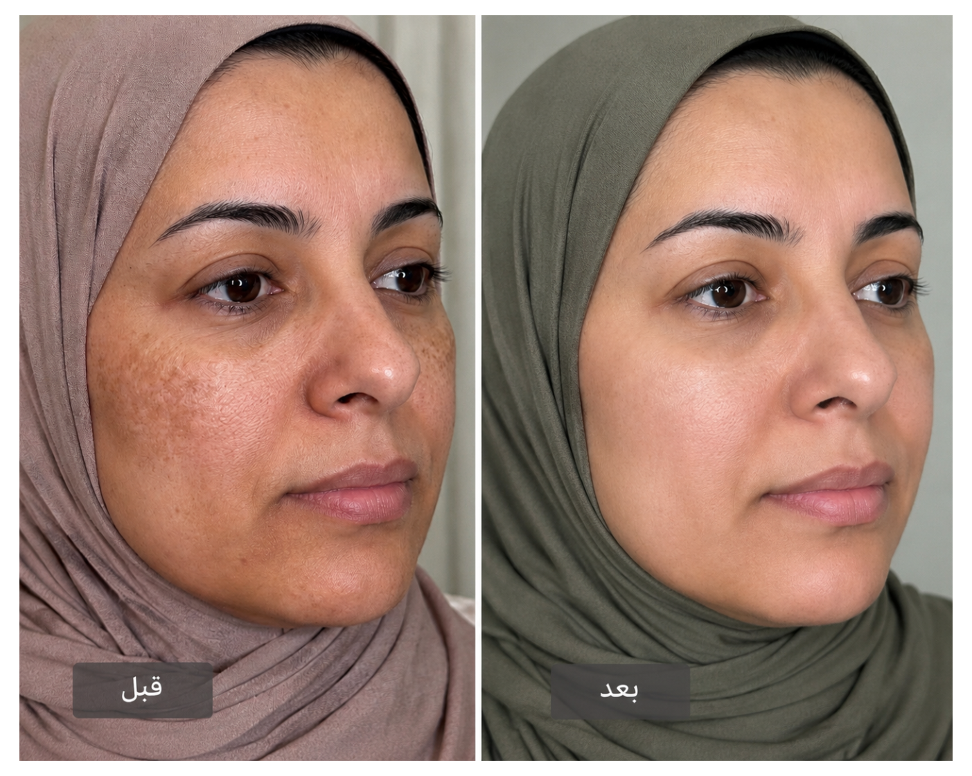 Before and after skincare transformation showing visible improvement in pigmentation, uneven skin tone, and overall skin radiance after using the Derma Botox 3-Step Skincare Routine.