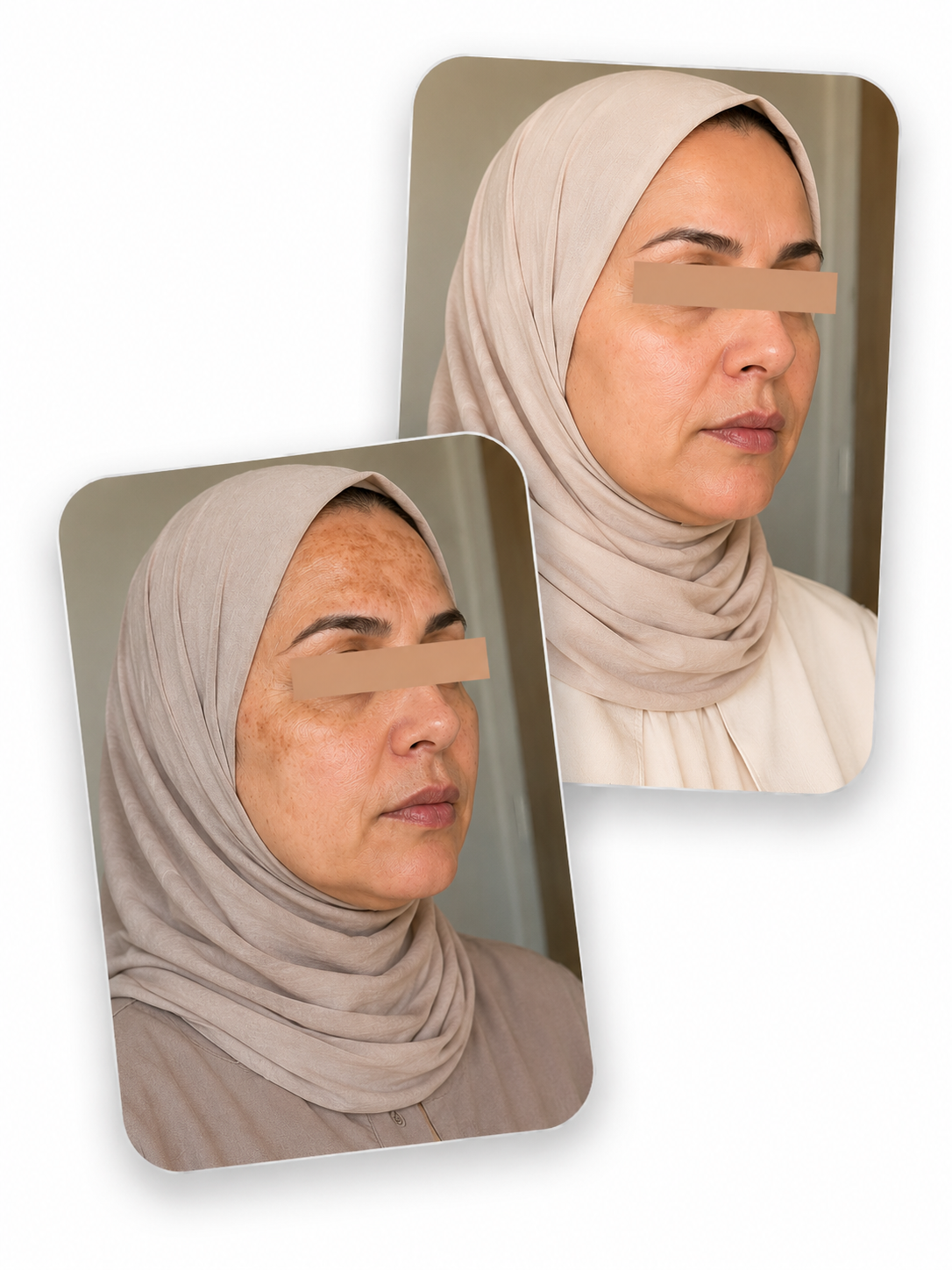 Before and after pigmentation improvement using the Derma Botox skincare routine on a woman wearing a beige hijab.
