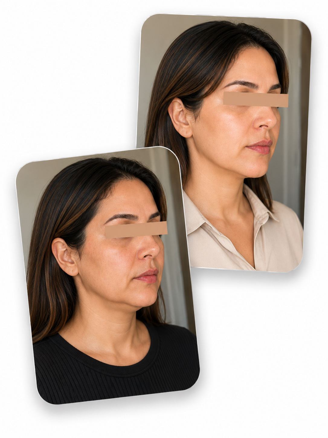 Before and after facial volume restoration using the Derma Botox skincare routine, showing improved skin firmness and a naturally plumper appearance.