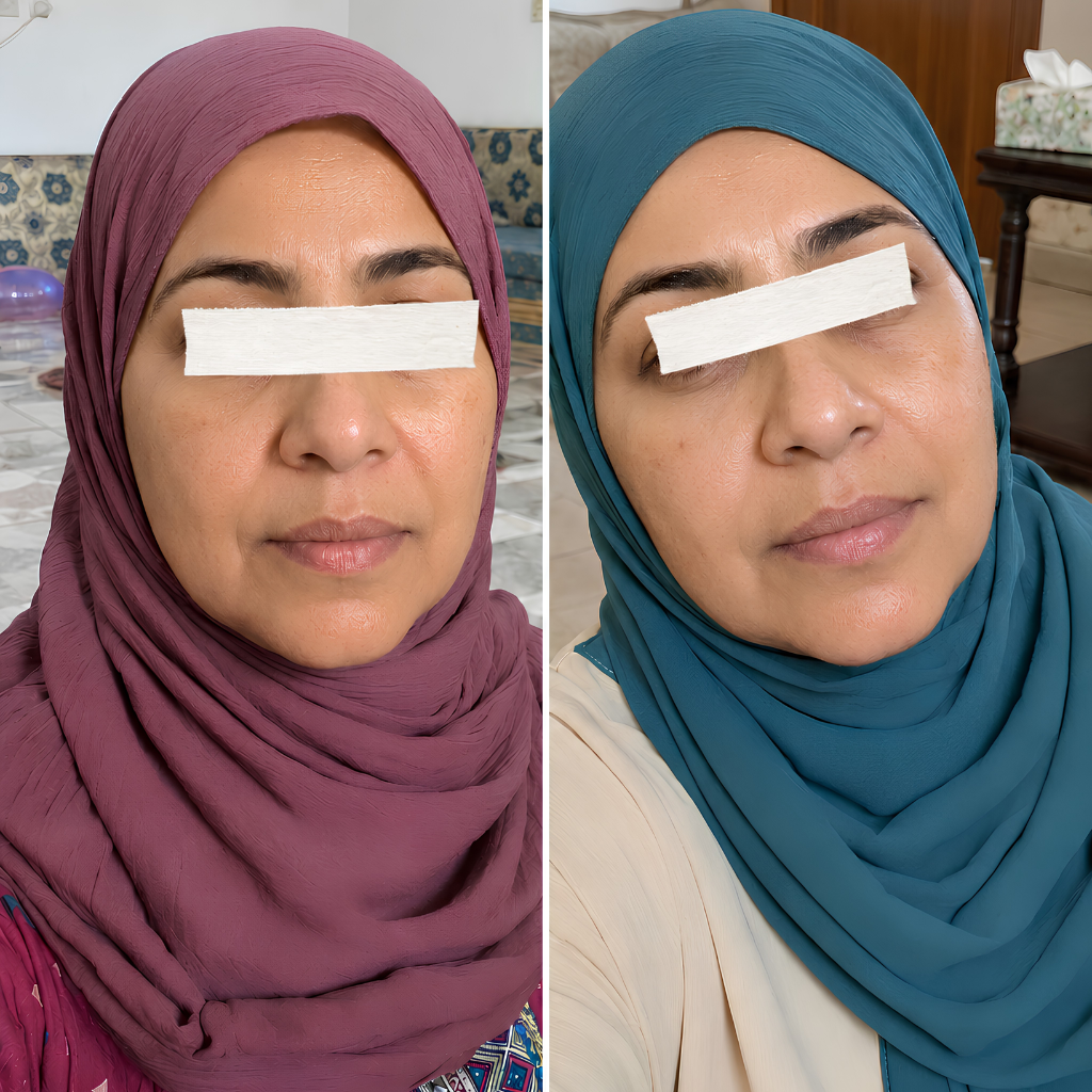 Before and after using the Derma Botox skincare routine, showing smoother, brighter-looking skin.