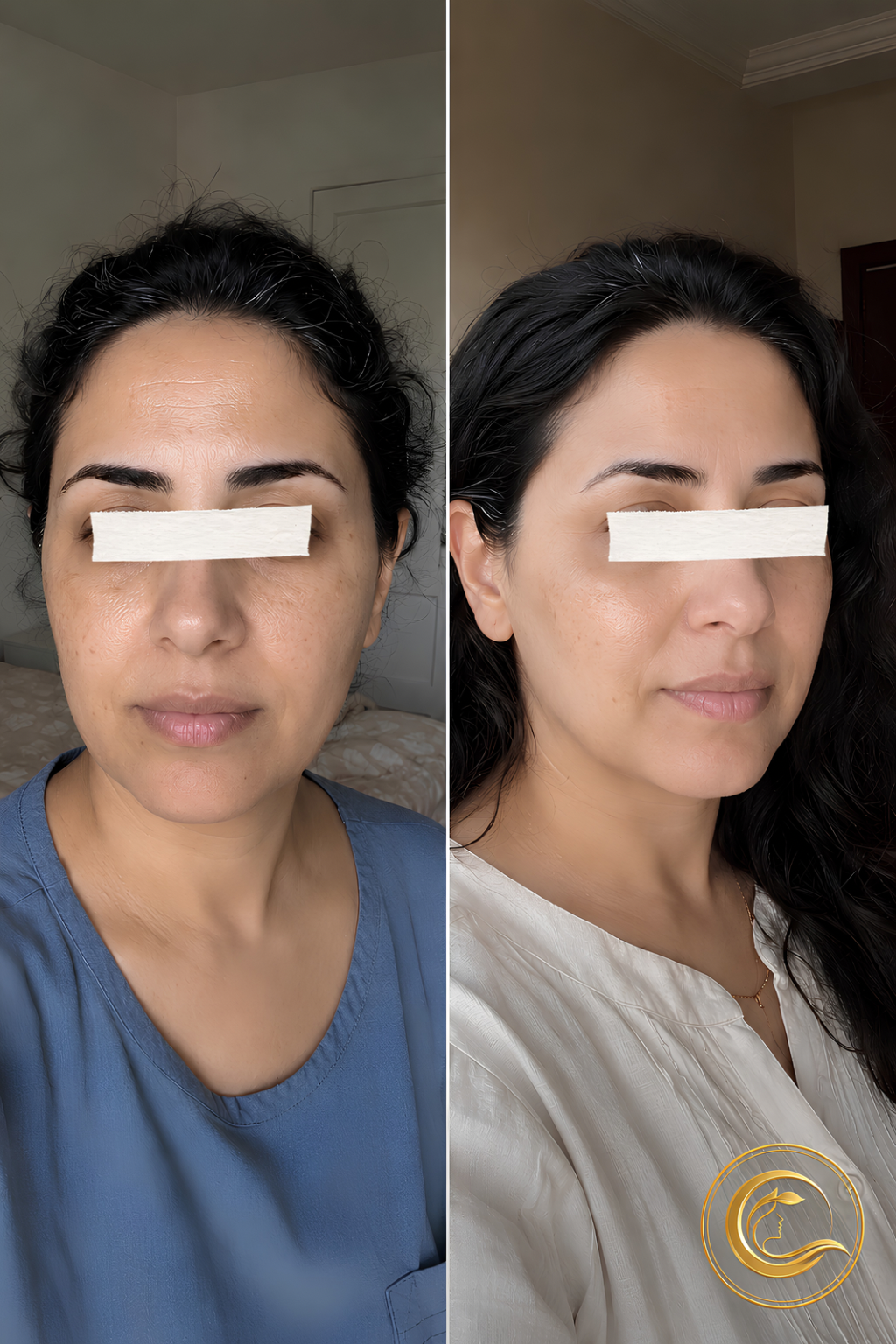 Before and after using the Derma Botox skincare routine, showing smoother, brighter-looking skin.
