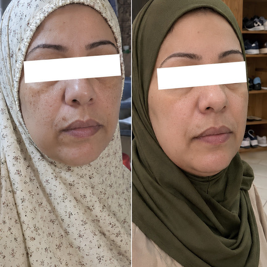 Before and after using the Derma Botox skincare routine, showing brighter, smoother and more even-looking skin.