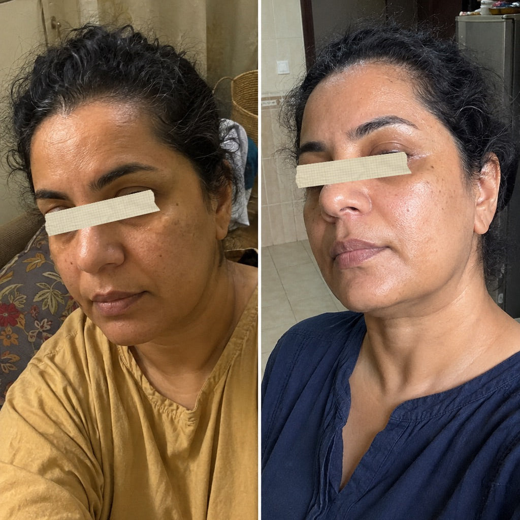 Before and after using the Derma Botox skincare routine, showing smoother, brighter-looking skin.