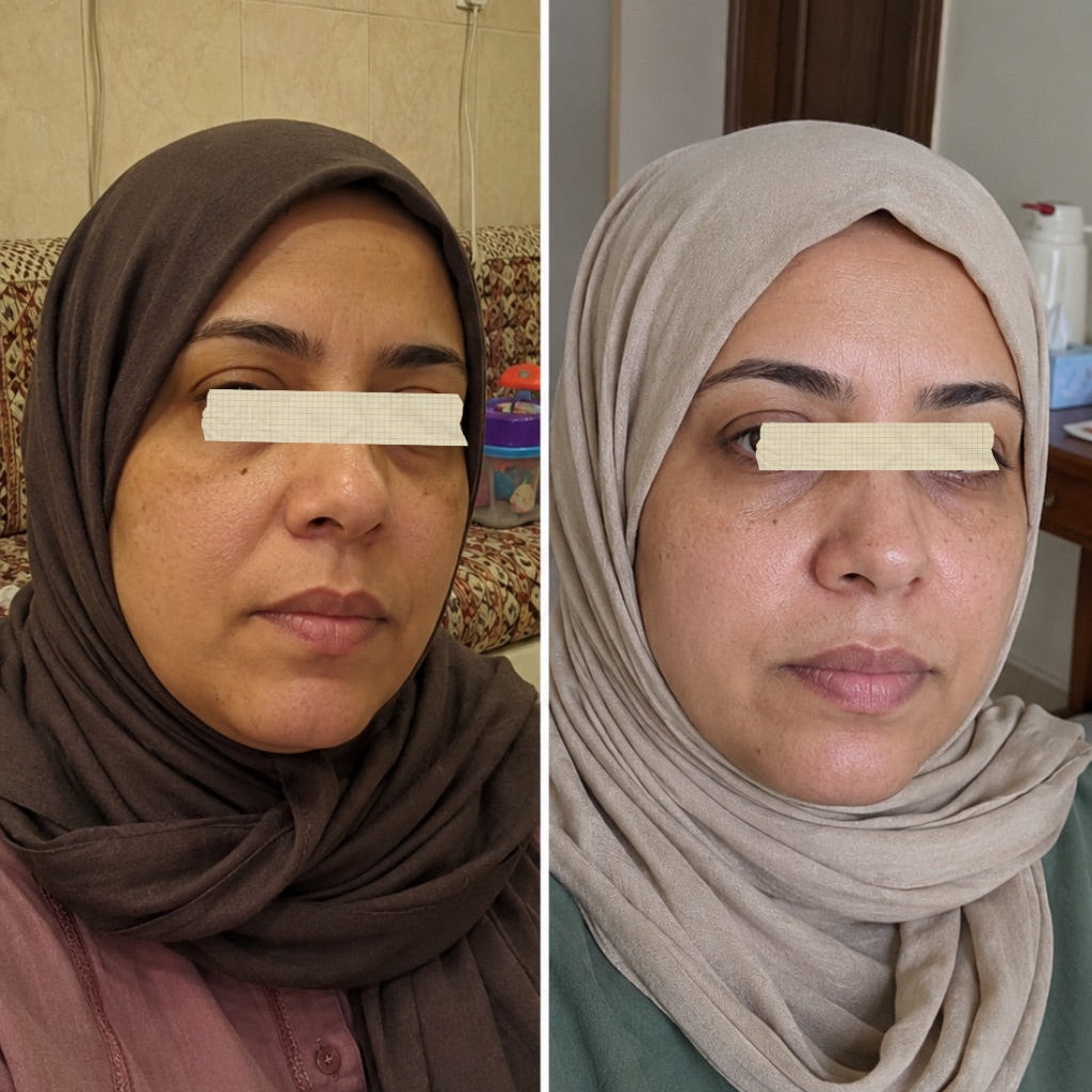 Before and after using the Derma Botox skincare routine, showing smoother, brighter-looking skin.